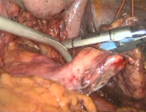 Coaxial curved instruments in laparoscopic pancreatic resection
